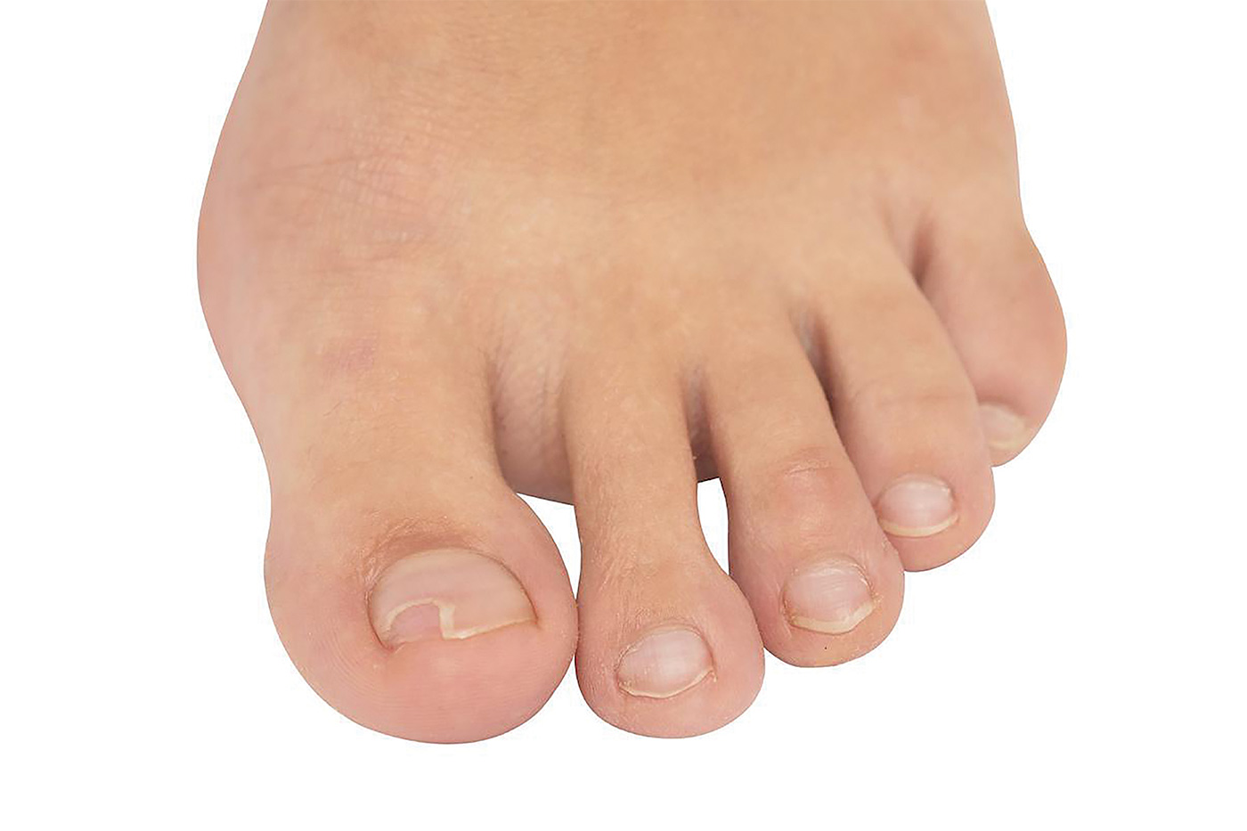 How to Treat and Look After Ingrown Nails StyleSpeak